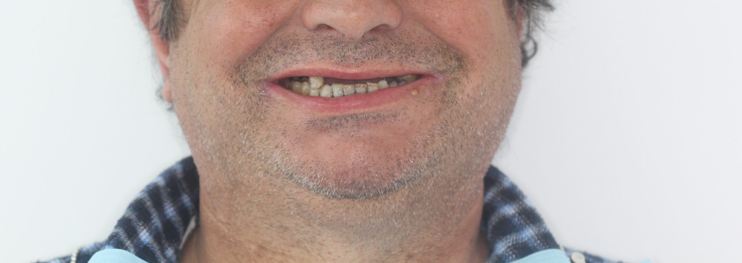 Antes