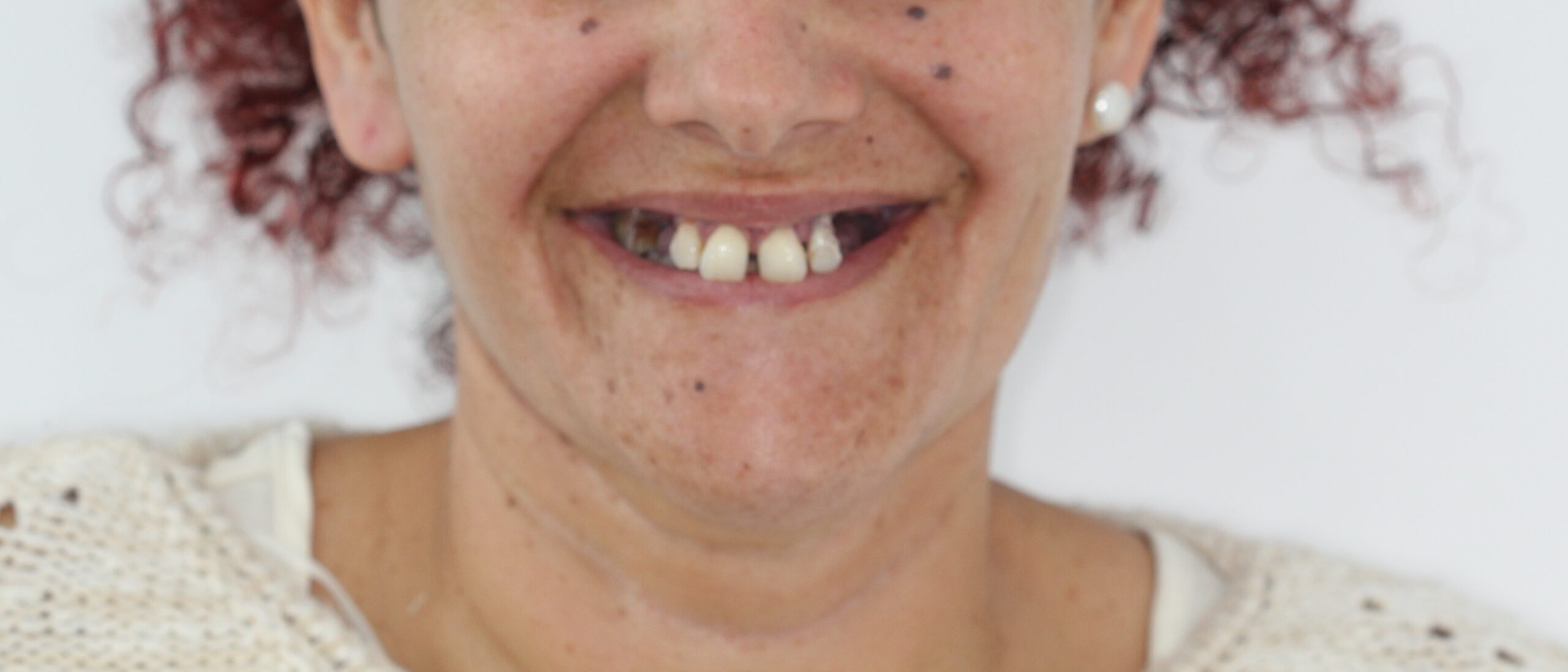 Antes