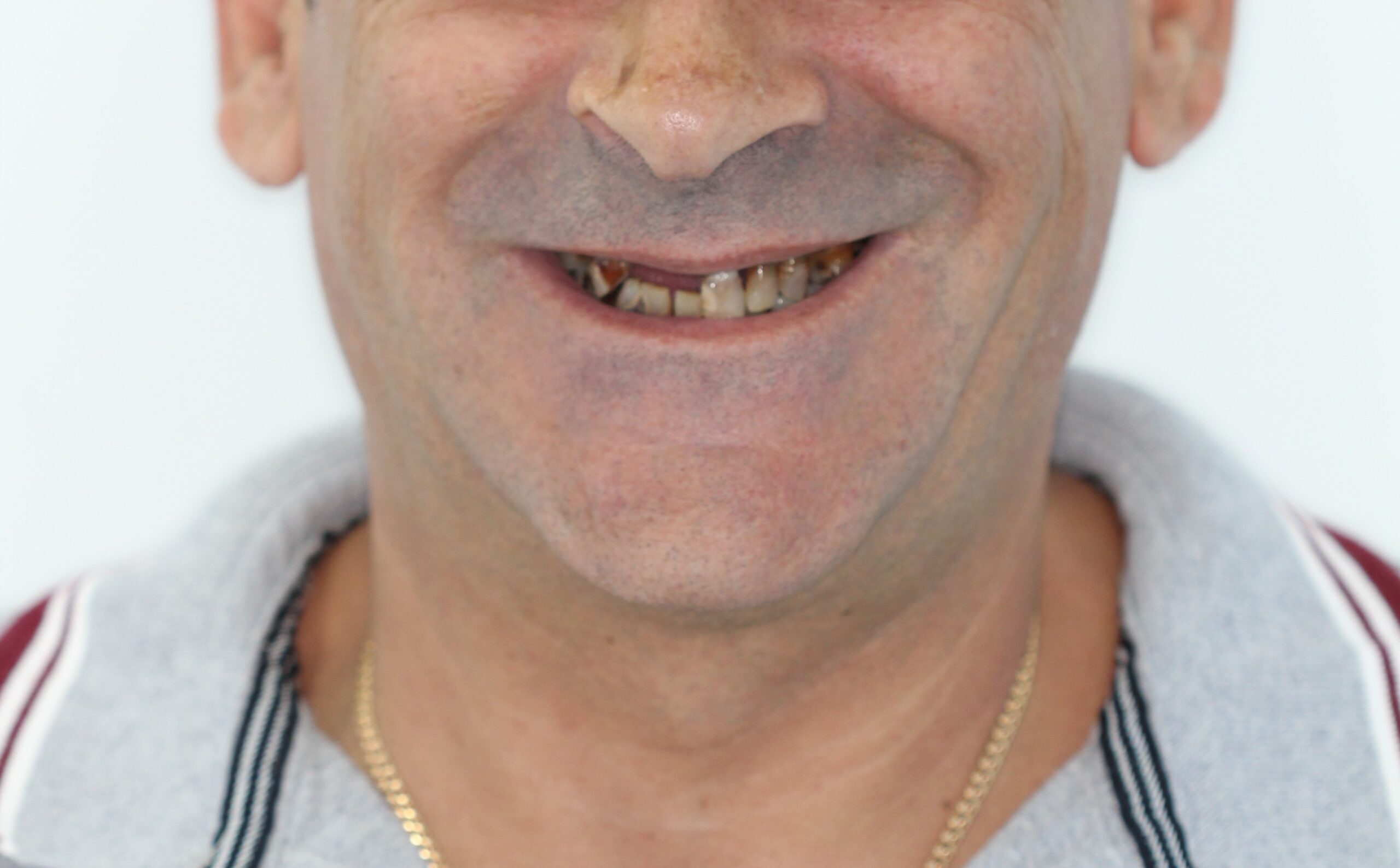 Antes